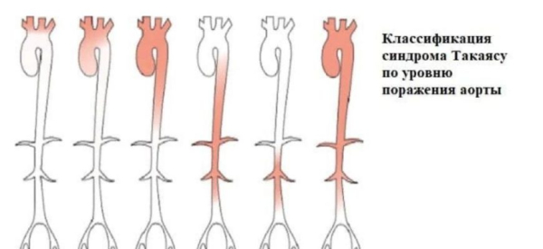 Синдром (болезнь) Такаясу