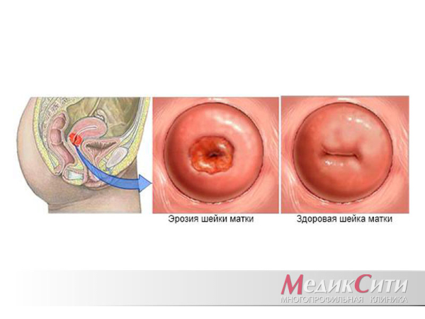 Последствия прижигания эрозии шейки матки у нерожавших