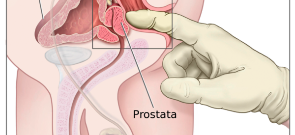 Массаж простаты &ndash; польза и вред для мужчин, специфика выполнения