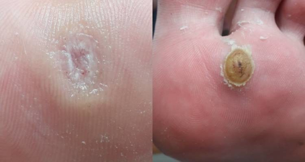 Эффективные методы для лечения бородавок на пальце ноги