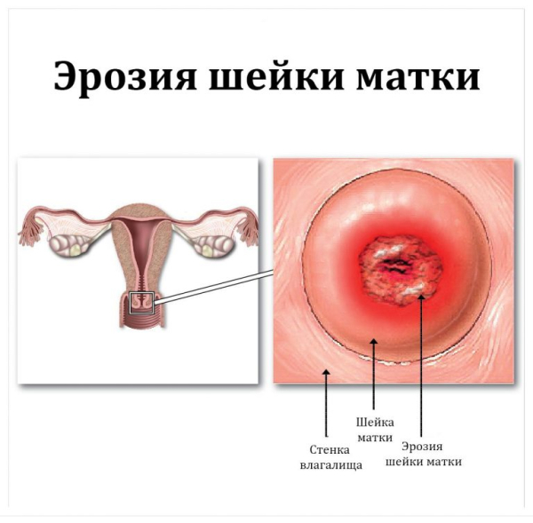 Последствия прижигания эрозии шейки матки у нерожавших