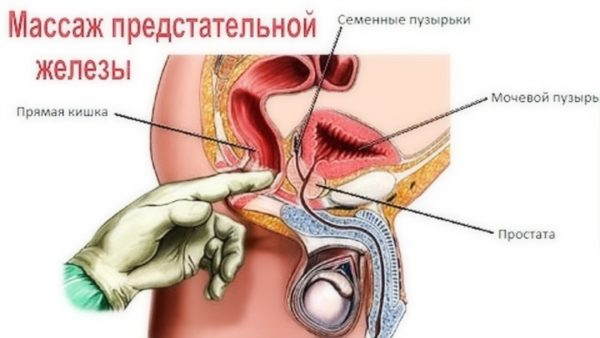 Массаж простаты &ndash; польза и вред для мужчин, специфика выполнения