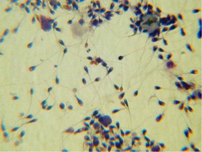 Обнаружена агрегация сперматозоидов: причины и действия