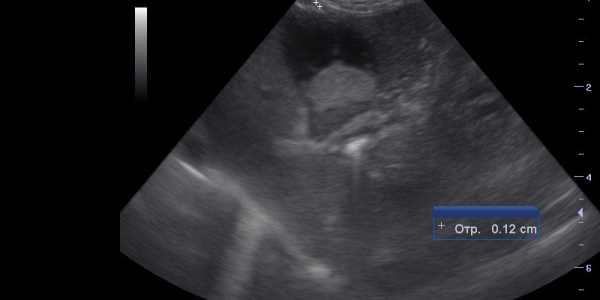 УЗИ желчного пузыря и печени