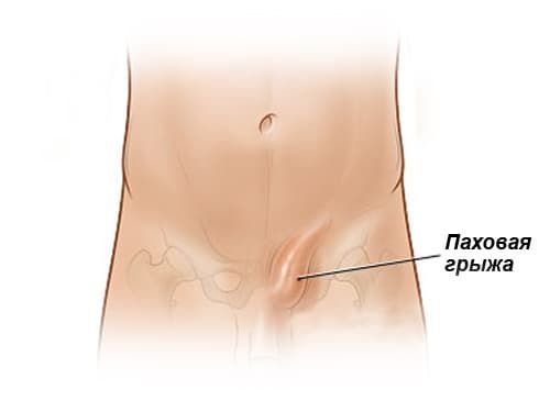 Паховая грыжа у мужчин: причины, симптомы и лечение, профилактика