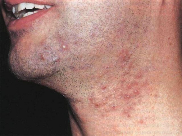 Стафилококковый фолликулит: что это такое и как его лечить