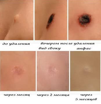 Правильный уход за раной после лазерного удаления бородавки