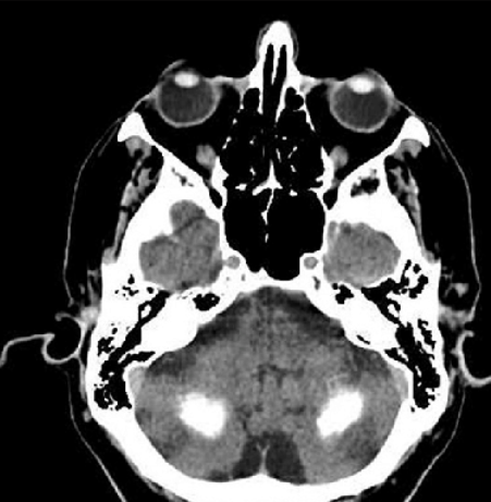 Синдром Фара &mdash; тяжелое нейродегенеративное заболевание ЦНС
