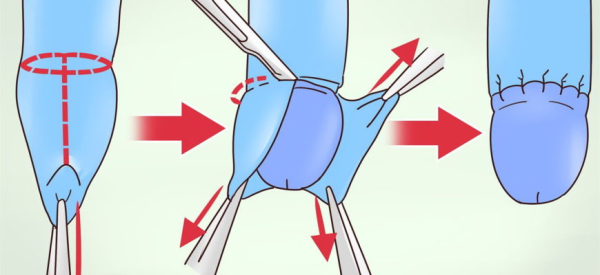 Что такое &laquo;смегма&raquo; у мальчиков и мужчин, опасность, как ее убрать