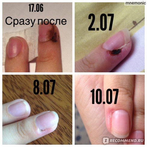 Как и сколько заживает бородавка после удаления азотом