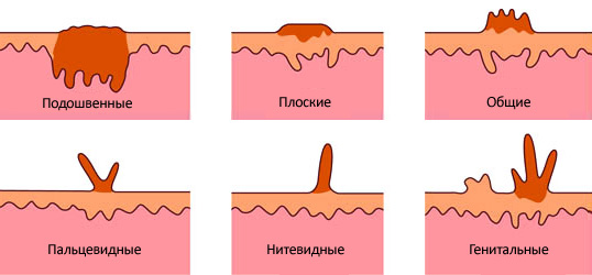 Отличие папилломы от кондиломы