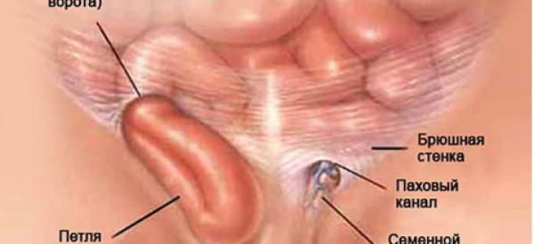 Паховая грыжа у мужчин: причины, симптомы и лечение, профилактика