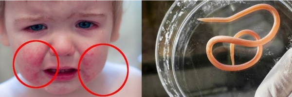 Гельминтоз у малыша: как родителям определить паразитов после дефекации