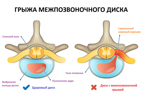 Может ли быть температура при остеохондрозе?