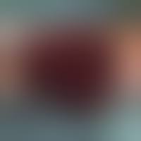 Мезентериальный тромбоз кишечника: что это такое, симптомы, лечение, прогноз