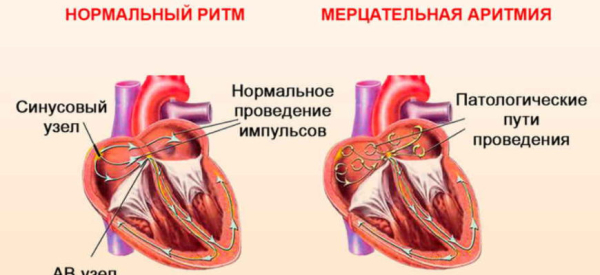 Связь остеохондроза и аритмии: причины, диагностика, лечение