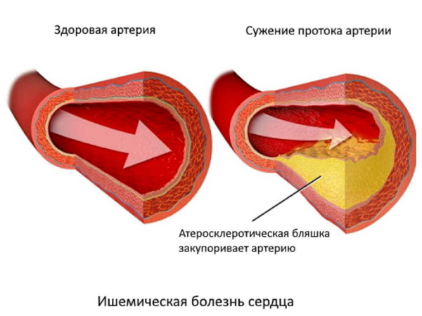 Атеросклеротическая болезнь сердца: симптомы, лечение, причина смерти