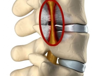 Корешковый синдром шейного отдела позвоночника: симптомы и лечение