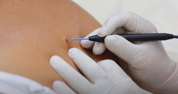 Радиоволновой метод удаления папиллом