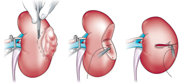 Удаление почки посредством лапароскопического метода