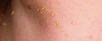 Бородавка и папиллома: основные отличия