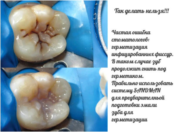 Герметизация фиссур зубов у детей и взрослых: что это, за и против