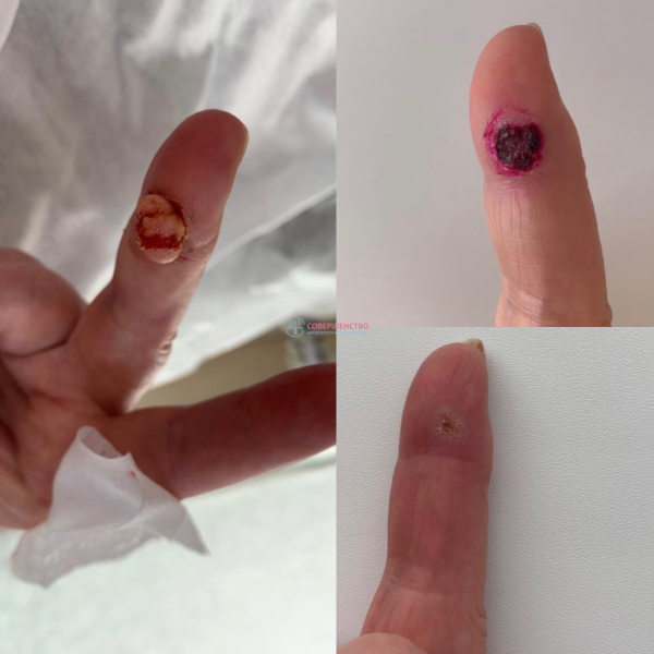 Удаление бородавки жидким азотом: последствия процедуры