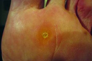 Вирусная бородавка на ноге: причины, симптомы и лечение