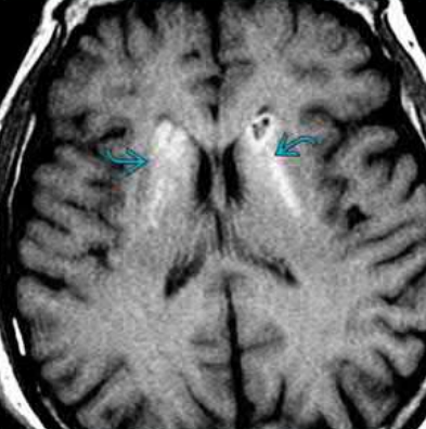 Синдром Фара &mdash; тяжелое нейродегенеративное заболевание ЦНС