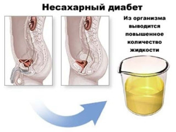 Несахарный диабет: причины, симптомы, диагностика, лечение
