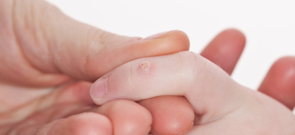 Что такое вульгарная бородавка: причины, симптомы и лечение