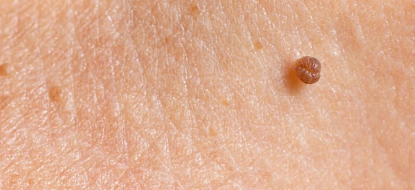 Папиллома голосовых связок: причины, симптомы и лечение