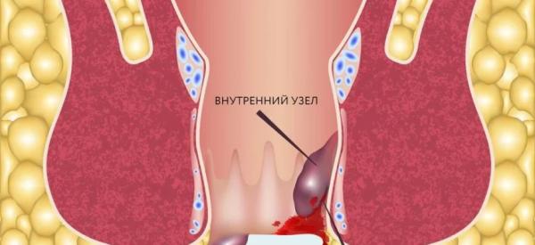 Кровь из заднего прохода, причины, кровотечение при геморрое