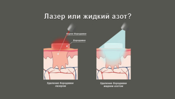 Как и сколько заживает бородавка после удаления азотом