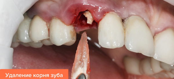 Удаление корня разрушенного или гнилого зуба: больно ли, процесс удаления