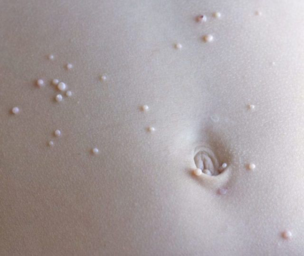 Бородавки у детей на животе