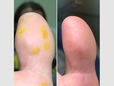 Как обрабатывать бородавку после прижигания азотом