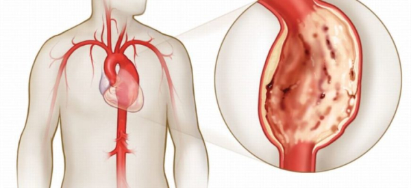 Атеросклероз отдела брюшной аорты: причины и симптомы