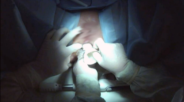 Операция Лонго при геморрое: особенности, подготовка, противопоказания, цена, отзывы