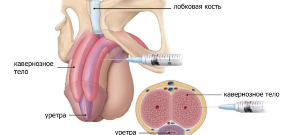 Применение уколов и таблеток Папаверина для повышения потенции