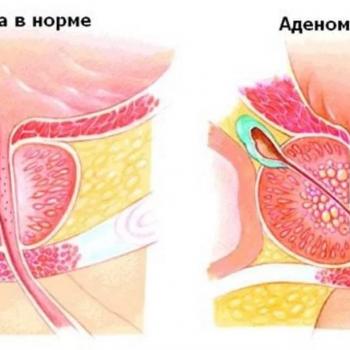 Лечение простатита и аденомы простаты луковой шелухой у мужчин