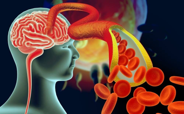 Дисциркуляторная энцефалопатия (ДЭП): развитие и диагноз, симптомы и стадии, терапия