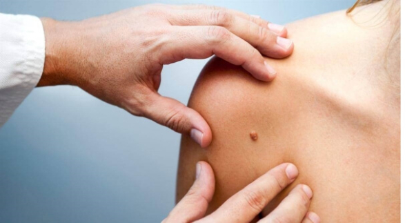 Папиллома на внутренней стороне бедра: причины и лечение