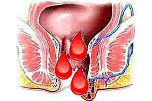 Кровь из заднего прохода, причины, кровотечение при геморрое