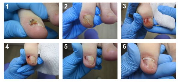 Что такое вирусная бородавка: симптомы и лечение