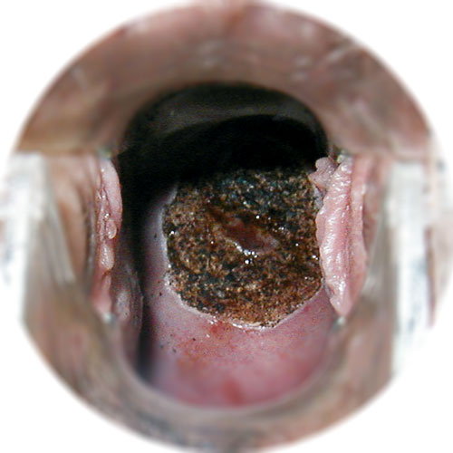 Последствия прижигания эрозии шейки матки у нерожавших