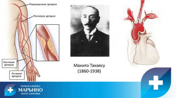 Синдром (болезнь) Такаясу