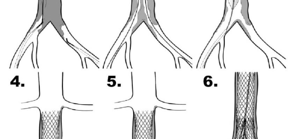 Реканализация тромба (вен, артерий): механизм, виды и способы