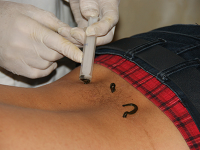 Лечение импотенции пиявками &mdash; что нужно знать мужчине