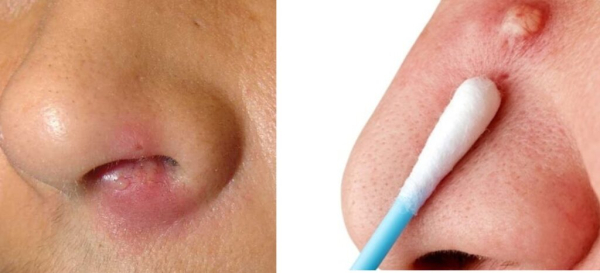 Как устранить отек после фурункула?